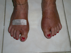 Dr. Galati Foot Deformities Images