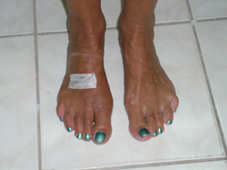 Dr. Galati Foot Deformities Images