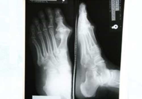 before after foot deformaties5a